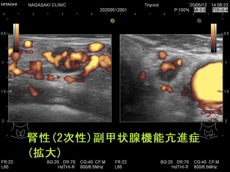 腎性(2次性)副甲状腺機能亢進症(拡大) 超音波(エコー)画像 ドプラーモード 腎性(2次性)副甲状腺機能亢進症(拡大) 超音波(エコー)画像 ドプラーモード