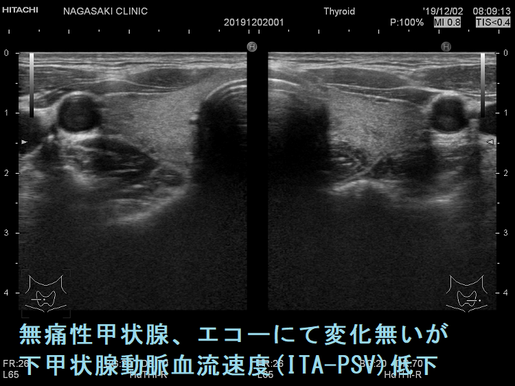 無痛性甲状腺、エコーにて変化無いが下甲状腺動脈血流速度(ITA-PSV)低下2 無痛性甲状腺、エコーにて変化無いが下甲状腺動脈血流速度(ITA-PSV)低下2