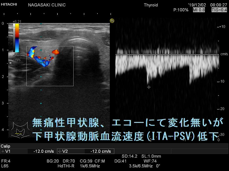 無痛性甲状腺、エコーにて変化無いが下甲状腺動脈血流速度(ITA-PSV)低下 無痛性甲状腺、エコーにて変化無いが下甲状腺動脈血流速度(ITA-PSV)低下