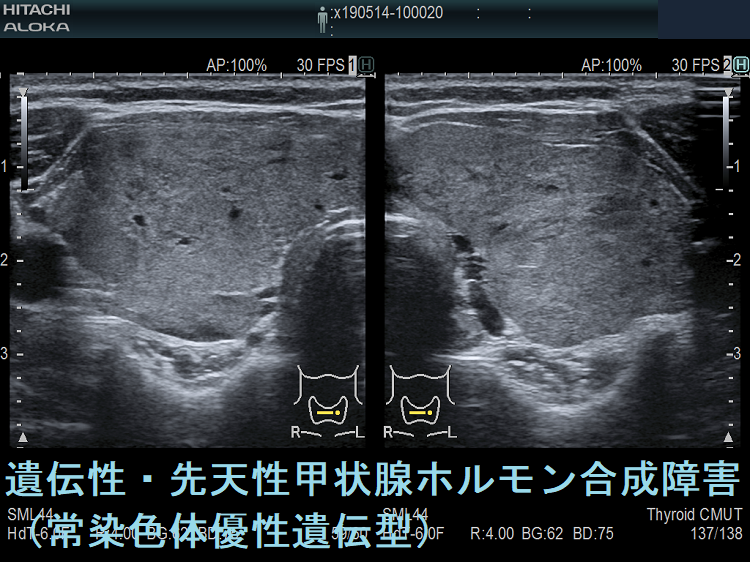 遺伝性・先天性甲状腺ホルモン合成障害 (常染色体優性遺伝型)超音波エコー画像(水平断) 遺伝性・先天性甲状腺ホルモン合成障害 (常染色体優性遺伝型)超音波エコー画像(水平断)