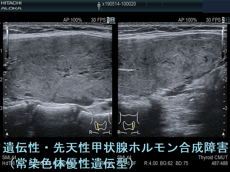遺伝性・先天性甲状腺ホルモン合成障害 (常染色体優性遺伝型)超音波エコー画像(垂直断) 遺伝性・先天性甲状腺ホルモン合成障害 (常染色体優性遺伝型)超音波エコー画像(垂直断)