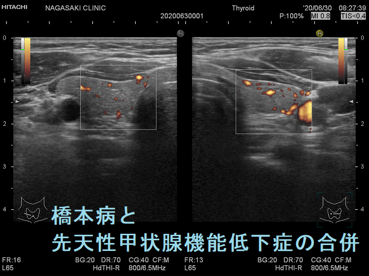 橋本病と先天性甲状腺機能低下症の合併 超音波(エコー)画像 ドプラーモード 橋本病と先天性甲状腺機能低下症の合併 超音波(エコー)画像 ドプラーモード