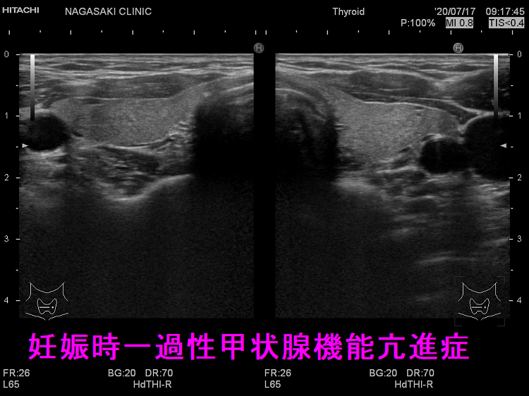 妊娠時一過性甲状腺機能亢進症の超音波(エコー)画像 妊娠時一過性甲状腺機能亢進症の超音波(エコー)画像