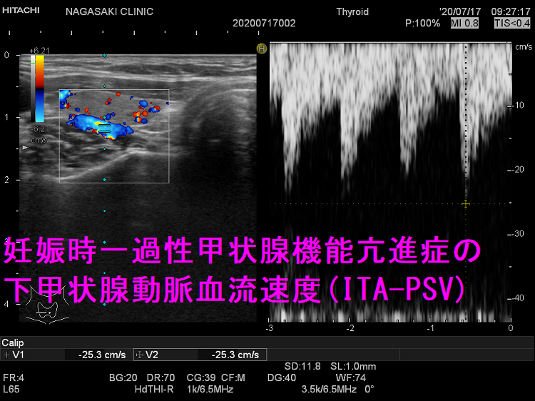 妊娠時一過性甲状腺機能亢進症の下甲状腺動脈血流速度(ITA-PSV) 妊娠時一過性甲状腺機能亢進症の下甲状腺動脈血流速度(ITA-PSV)