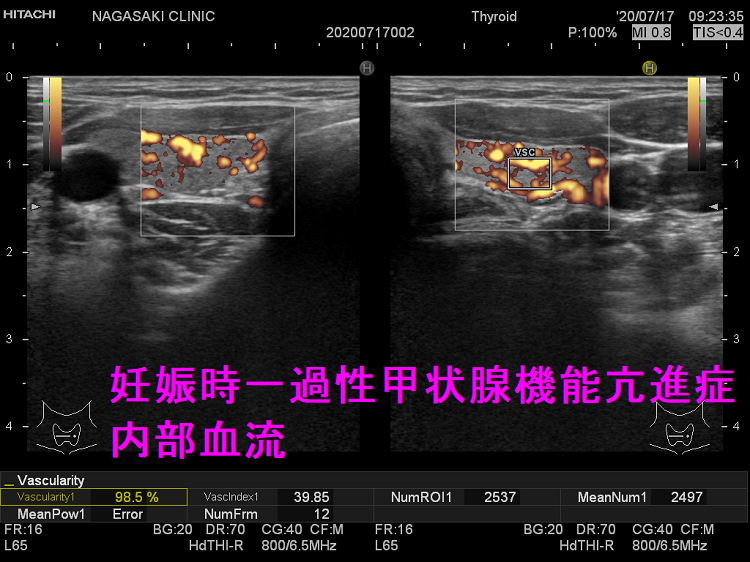 妊娠時一過性甲状腺機能亢進症 内部血流 妊娠時一過性甲状腺機能亢進症 内部血流