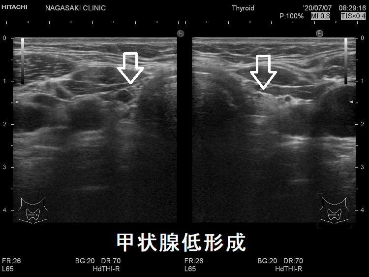甲状腺低形成 超音波(エコー)画像 甲状腺低形成 超音波(エコー)画像