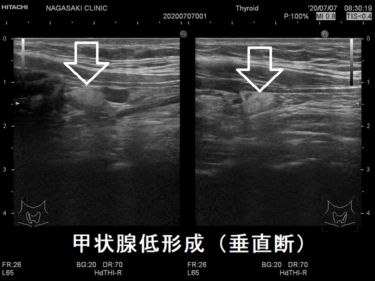 甲状腺低形成 超音波(エコー)画像(垂直断) 甲状腺低形成 超音波(エコー)画像(垂直断)