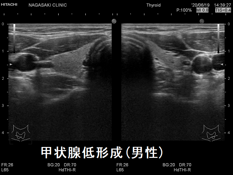 甲状腺低形成(男性) 超音波(エコー)画像 甲状腺低形成(男性) 超音波(エコー)画像
