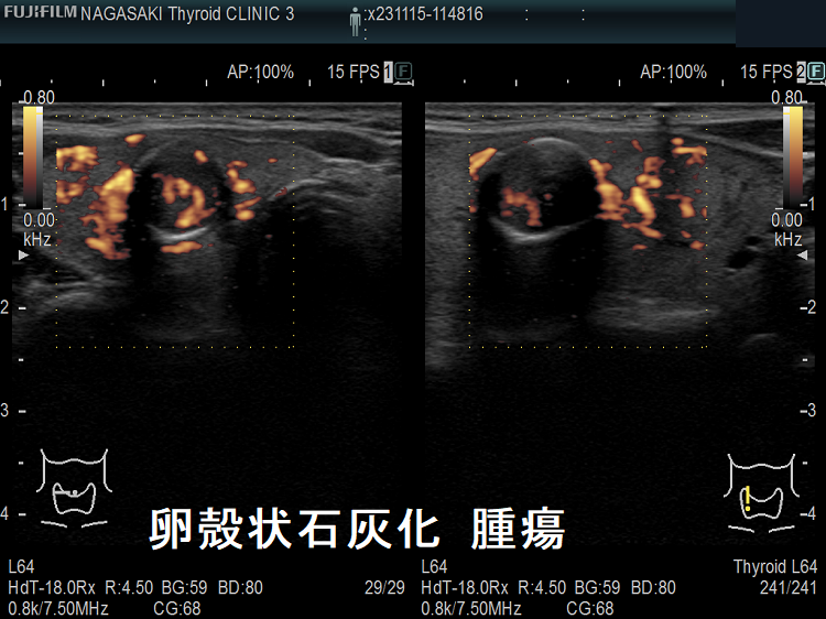 卵殻状石灰化 濾胞性腫瘍 ドプラーモード 卵殻状石灰化 濾胞性腫瘍 ドプラーモード