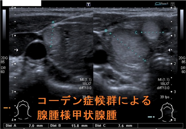 コーデン症候群による腺腫様甲状腺腫 コーデン(Cowden)症候群による腺腫様甲状腺腫2