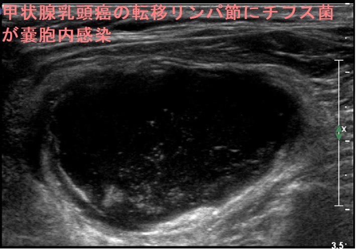 甲状腺乳頭癌の転移リンパ節にチフス菌が嚢胞内感染 超音波(エコー)画像 甲状腺乳頭癌の転移リンパ節にチフス菌が嚢胞内感染 超音波(エコー)画像