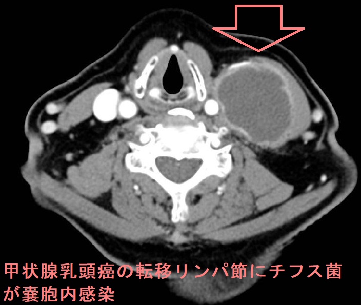 甲状腺乳頭癌の転移リンパ節にチフス菌が嚢胞内感染 造影CT画像 甲状腺乳頭癌の転移リンパ節にチフス菌が嚢胞内感染 造影CT画像