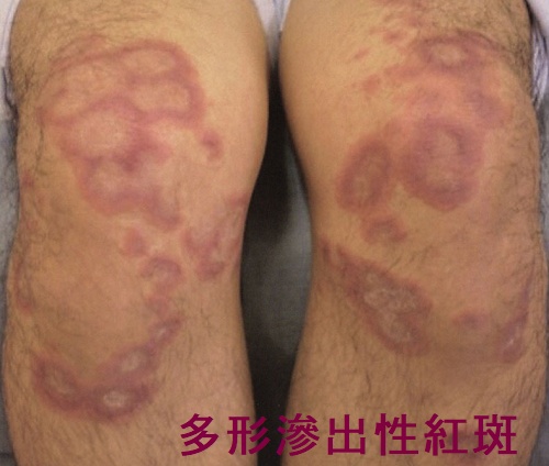 多形滲出性紅斑 多形滲出性紅斑