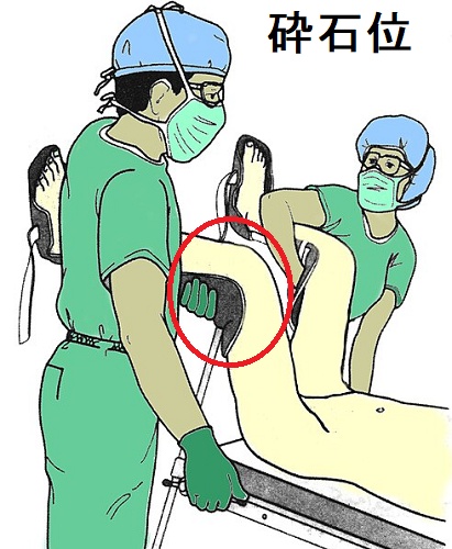 砕石位 砕石位