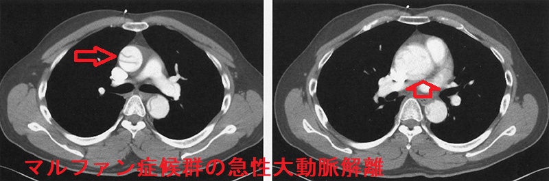 マルファン症候群の急性大動脈解離 胸部造影CT 水平断像 マルファン症候群の急性大動脈解離 胸部造影CT 水平断像