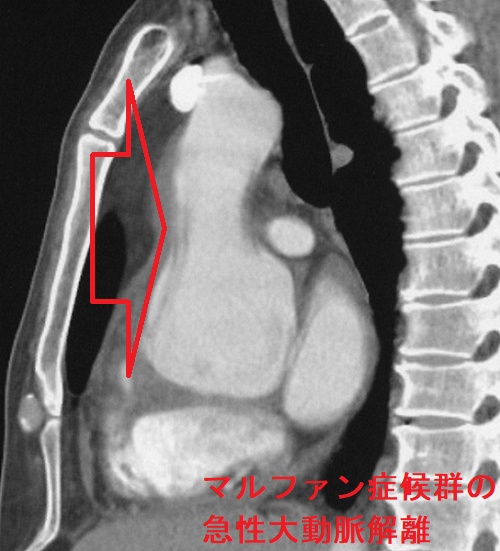 マルファン症候群の急性大動脈解離 胸部造影CT 矢状断像 マルファン症候群の急性大動脈解離 胸部造影CT 矢状断像