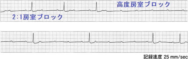 2:1 房室ブロック 高度房室ブロック 2:1 房室ブロック 高度房室ブロック
