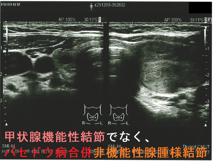 甲状腺機能性結節(機能性甲状腺腫)でなく、バセドウ病合併非機能性腺腫様結節 超音波(エコー)画像 (全体像 水平断) 甲状腺機能性結節(機能性甲状腺腫)でなく、バセドウ病合併非機能性腺腫様結節 超音波(エコー)画像 (全体像 水平断)