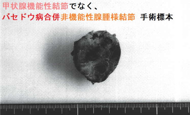 甲状腺機能性結節(機能性甲状腺腫)でなく、バセドウ病合併非機能性腺腫様結節 超音波(エコー)画像 (矢状断) 甲状腺機能性結節でなく、バセドウ病合併非機能性腺腫様結節 手術標本2