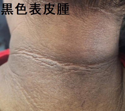 黒色表皮腫 黒色表皮腫