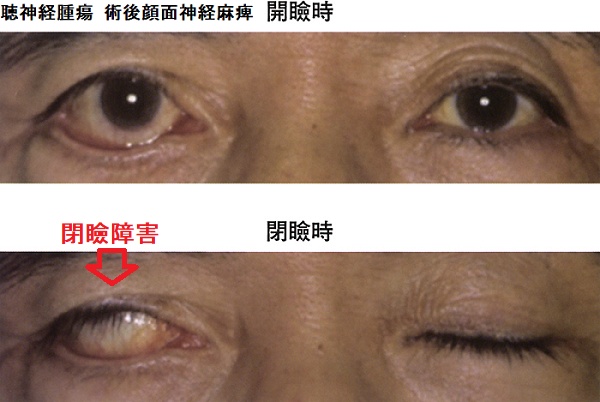 聴神経腫瘍 術後顔面神経麻痺 聴神経腫瘍 術後顔面神経麻痺