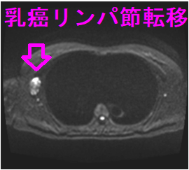 乳癌 リンパ節転移 MRI DWI(拡散強調画像)(水平断) 乳癌 リンパ節転移 MRI DWI(拡散強調画像)(水平断)