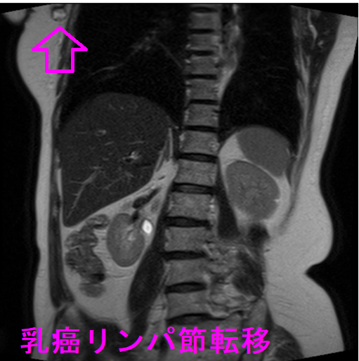 乳癌 リンパ節転移 MRI DWI(拡散強調画像)(冠状断) 乳癌 リンパ節転移 MRI DWI(拡散強調画像)(冠状断)