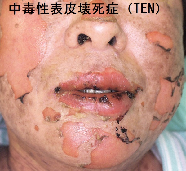 中毒性表皮壊死症(TEN) 中毒性表皮壊死症(TEN)