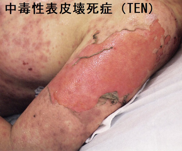 中毒性表皮壊死症(TEN) 中毒性表皮壊死症(TEN)2