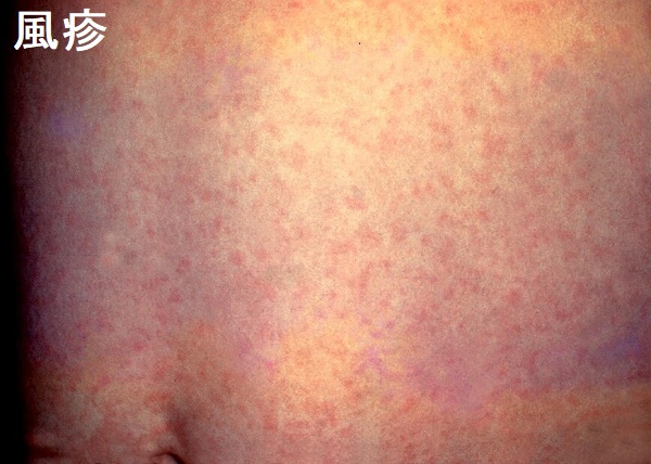 風疹 風疹