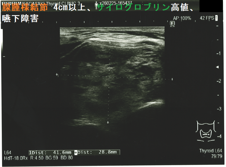 腺腫様結節 4cm以上、サイログロブリン高値(2,700 ng/mL 以上)、嚥下障害あり (水平断) 腺腫様結節 4cm以上、サイログロブリン高値(2,700 ng/mL 以上)、嚥下障害あり (水平断)