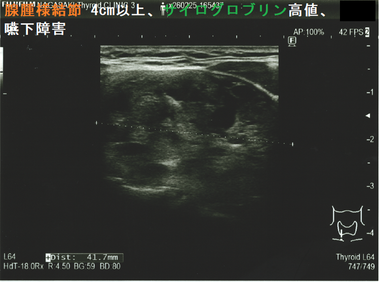 腺腫様結節 4cm以上、サイログロブリン高値(2,700 ng/mL 以上)、嚥下障害あり (矢状断) 腺腫様結節 4cm以上、サイログロブリン高値(2,700 ng/mL 以上)、嚥下障害あり (矢状断)