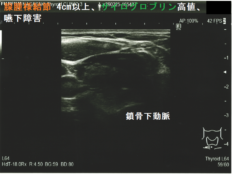 腺腫様結節 4cm以上、サイログロブリン高値(2,700 ng/mL 以上)、嚥下障害あり (水平断)縦隔伸展も伴う 腺腫様結節 4cm以上、サイログロブリン高値(2,700 ng/mL 以上)、嚥下障害あり (水平断)縦隔伸展も伴う