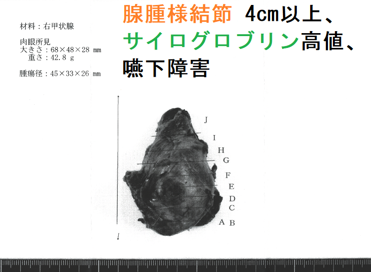 腺腫様結節 4cm以上、サイログロブリン高値(2,700 ng/mL 以上)、嚥下障害あり 手術標本 腺腫様結節 4cm以上、サイログロブリン高値(2,700 ng/mL 以上)、嚥下障害あり 手術標本