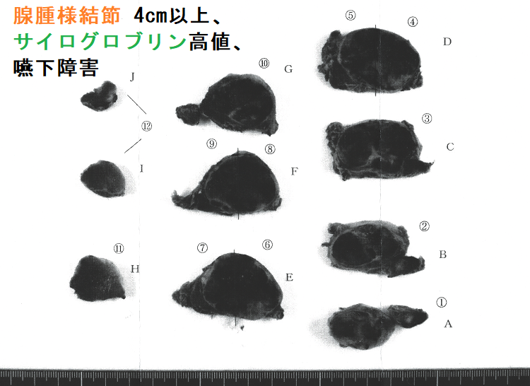 腺腫様結節 4cm以上、サイログロブリン高値(2,700 ng/mL 以上)、嚥下障害あり 手術標本 (割面) 腺腫様結節 4cm以上、サイログロブリン高値(2,700 ng/mL 以上)、嚥下障害あり 手術標本 (割面)