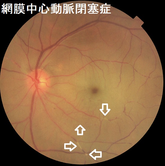 網膜中心動脈閉塞症 網膜中心動脈閉塞症