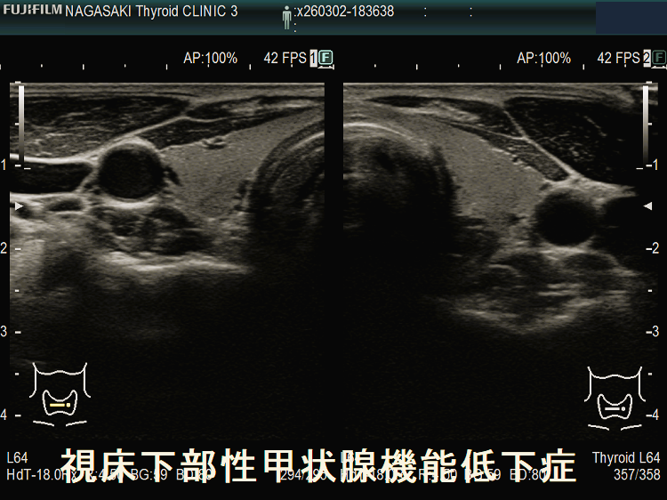 視床下部性甲状腺機能低下症(水平断) 男性 視床下部性甲状腺機能低下症 男性 2
