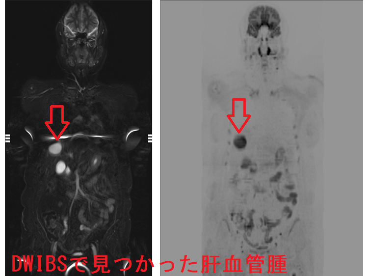 肝血管腫 DWIBS 肝血管腫 DWIBS