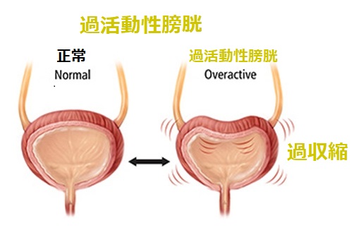 過活動性膀胱 過活動性膀胱