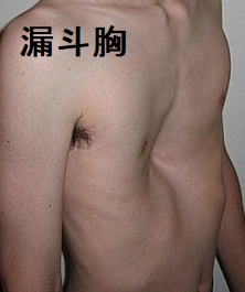 漏斗胸 漏斗胸