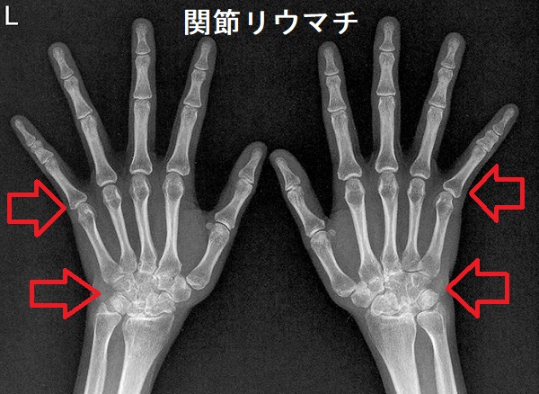 関節リウマチ 骨関節X線(レントゲン) 関節リウマチ 骨関節X線(レントゲン)
