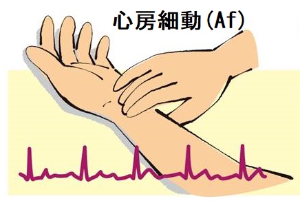 心房細動(Af)が家庭でみつかる 心房細動(Af)が家庭でみつかる
