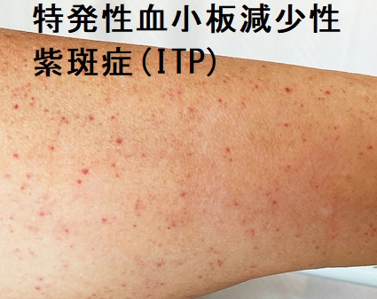 特発性・免疫性血小板減少性紫斑症(ITP) 特発性・免疫性血小板減少性紫斑症(ITP)