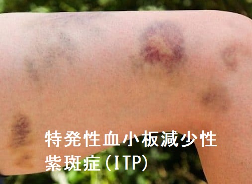 特発性血小板減少性紫斑症(ITP) 特発性血小板減少性紫斑症(ITP