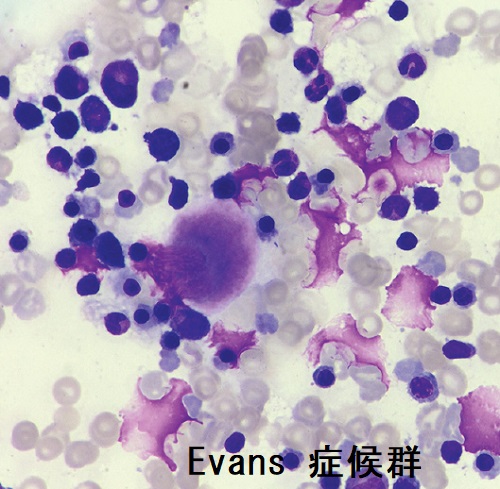 Evans 症候群 Evans 症候群