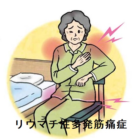 リウマチ性多発筋痛症 リウマチ性多発筋痛症