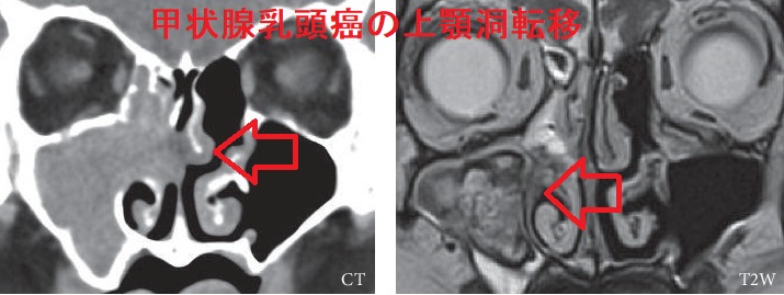 甲状腺乳頭癌の上顎洞転移 甲状腺乳頭癌の上顎洞転移