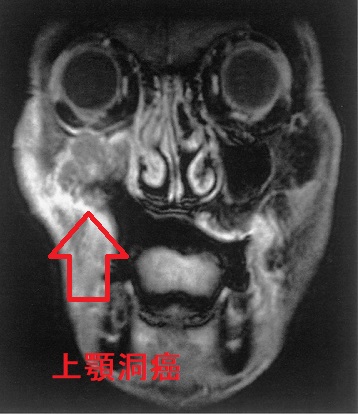 甲状腺と無関係の上顎洞癌 MRI画像 甲状腺と無関係の上顎洞癌 MRI画像