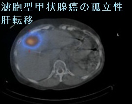 濾胞型甲状腺癌の孤立性肝転移 濾胞型甲状腺癌の孤立性肝転移