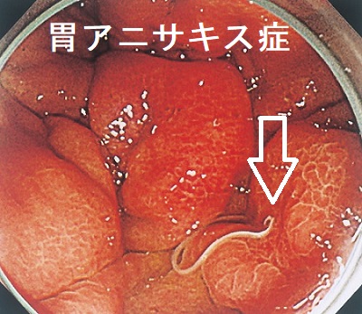 胃アニサキス症 胃アニサキス症